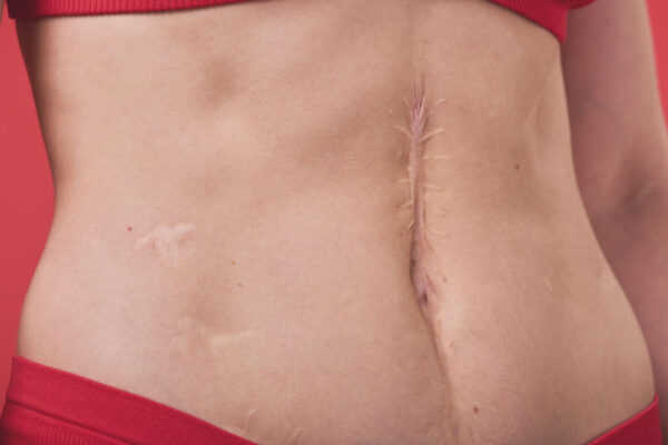 Cicatricile postoperatorii
