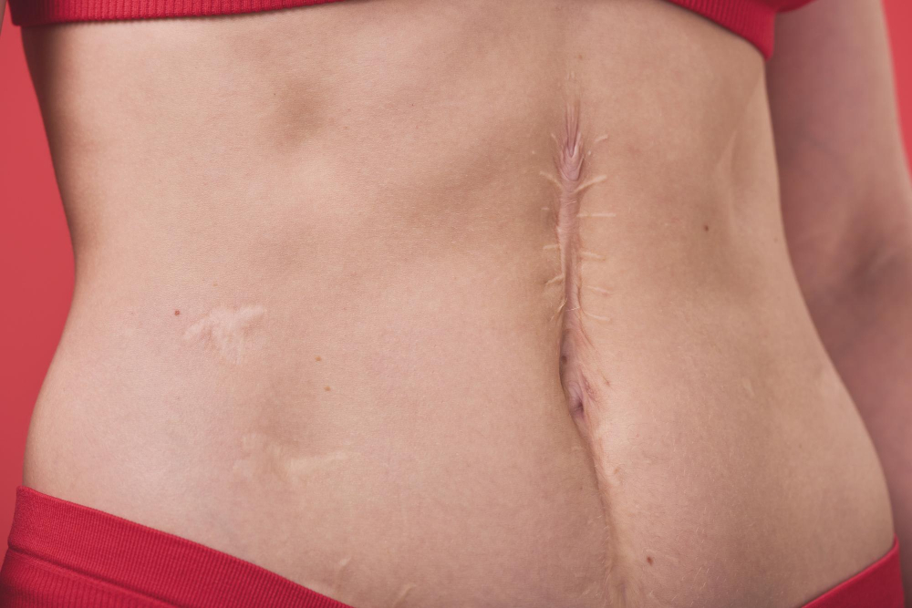 Cicatricile postoperatorii