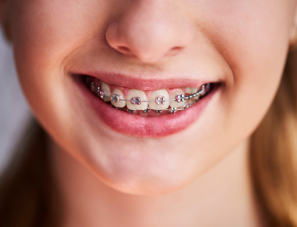 Copil zâmbind cu aparat dentar fix metalic pe dinți