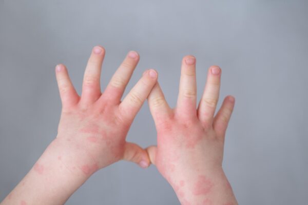 Introducerea alimentelor alergene: ce discuți dacă bebelușul are eczemă