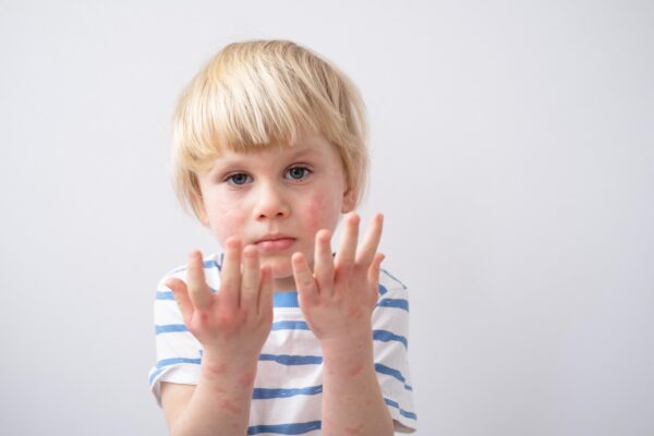 Erupție apărută după febră: ce informații îi transmiți pediatrului